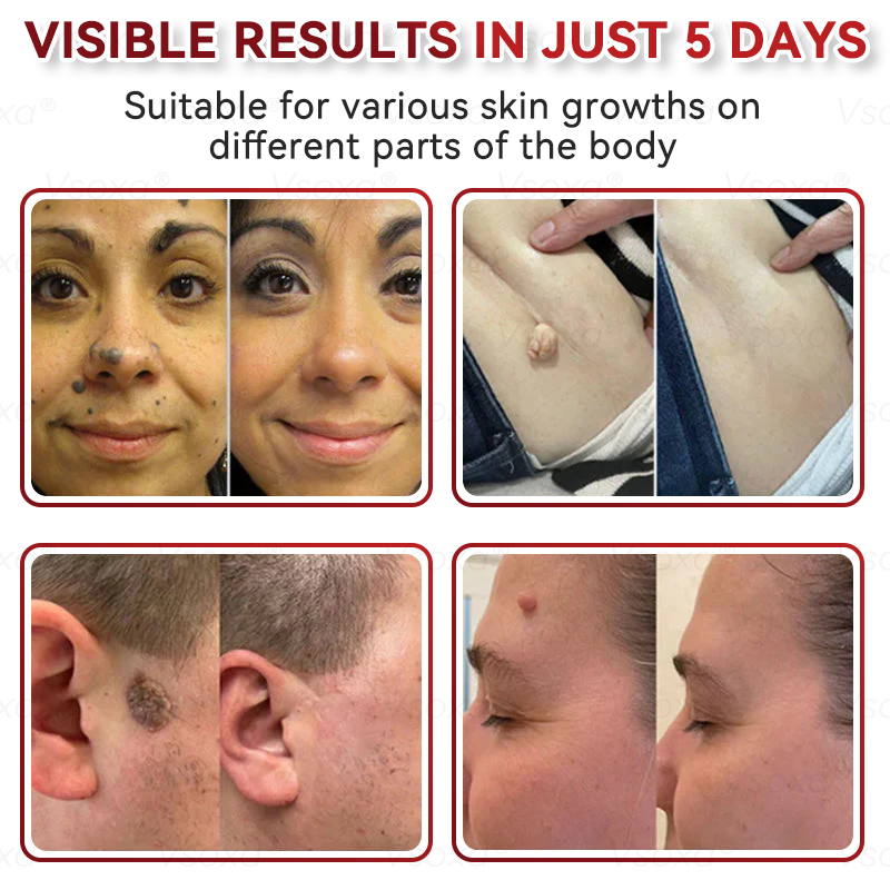 𝑉𝑠𝑜𝑥𝑎® 💧Microneedles Botanical Skin Tags Solution Patches - Made in the USA👩⚕️
