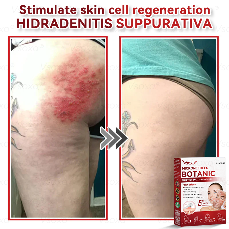 𝑉𝑠𝑜𝑥𝑎® 💧Microneedles Botanical Skin Tags Solution Patches - Made in the USA👩⚕️