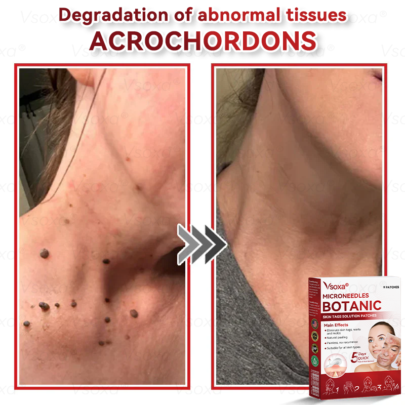 𝑉𝑠𝑜𝑥𝑎® 💧Microneedles Botanical Skin Tags Solution Patches - Made in the USA👩⚕️