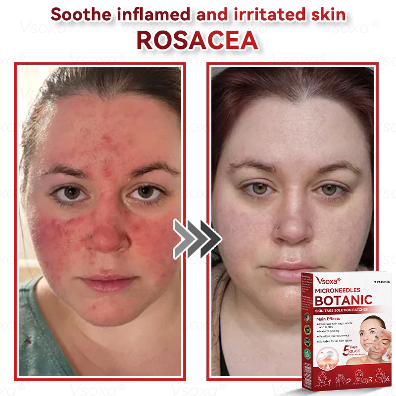 𝑉𝑠𝑜𝑥𝑎® 💧Microneedles Botanical Skin Tags Solution Patches - Made in the USA👩⚕️