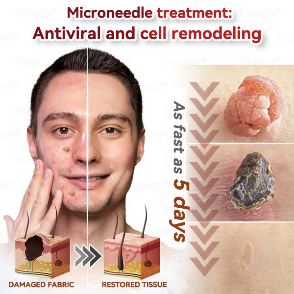 𝑉𝑠𝑜𝑥𝑎® 💧Microneedles Botanical Skin Tags Solution Patches - Made in the USA👩⚕️