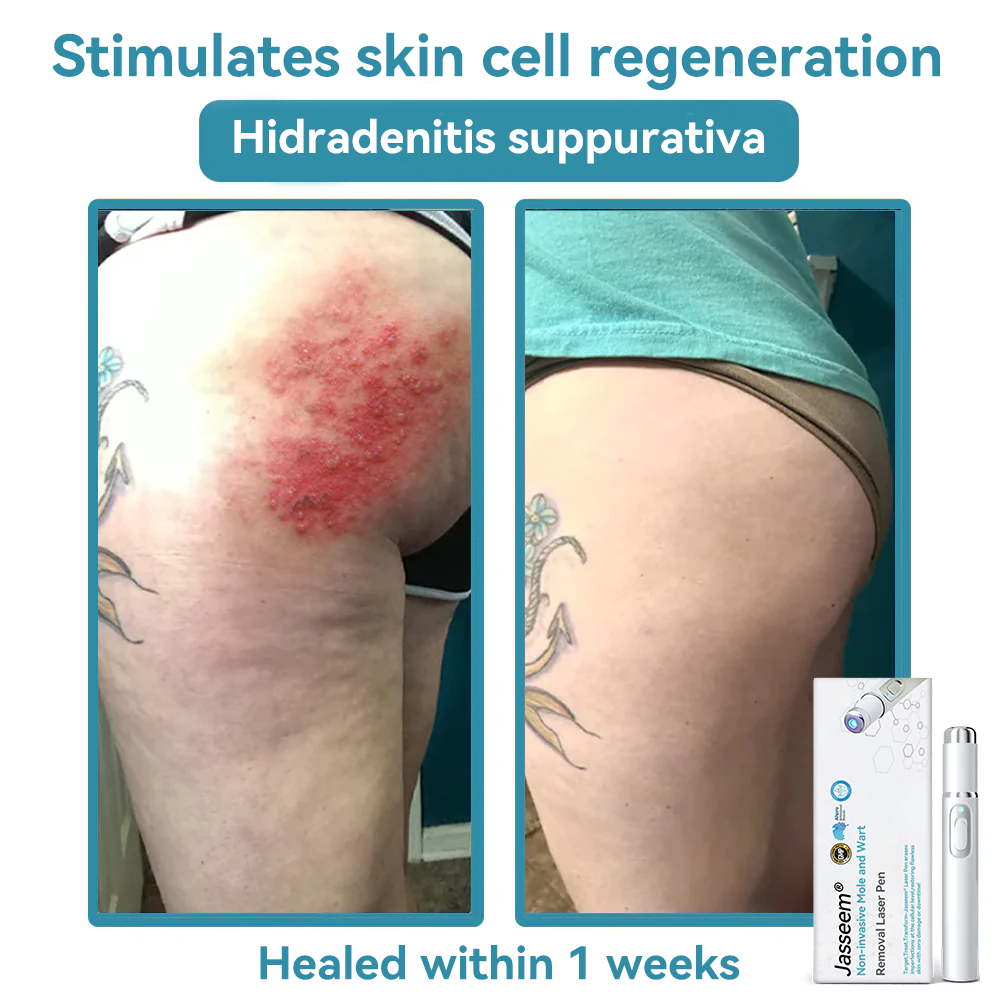 ๐๐๐ฌ๐ฌ๐๐๐ฆยฎ Medical-Grade Laser Pen ๐๐(Powered by COโ laser technology โ effectively removes moles, warts, skin tags, pigmentation marks, and other skin imperfections)