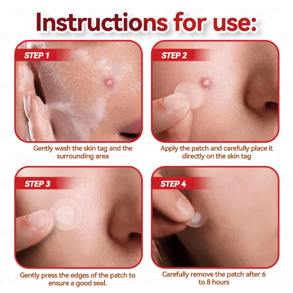 𝑉𝑠𝑜𝑥𝑎® 💧Microneedles Botanical Skin Tags Solution Patches - Made in the USA👩⚕️