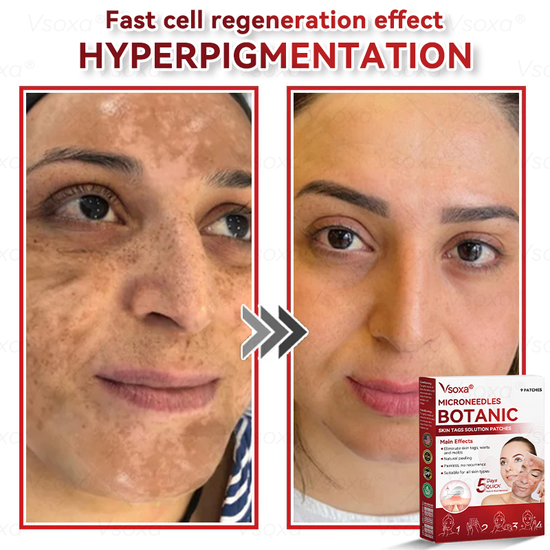 𝑉𝑠𝑜𝑥𝑎® 💧Microneedles Botanical Skin Tags Solution Patches - Made in the USA👩⚕️