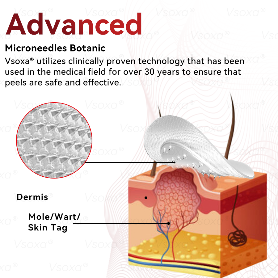 𝑉𝑠𝑜𝑥𝑎® 💧Microneedles Botanical Skin Tags Solution Patches - Made in the USA👩⚕️
