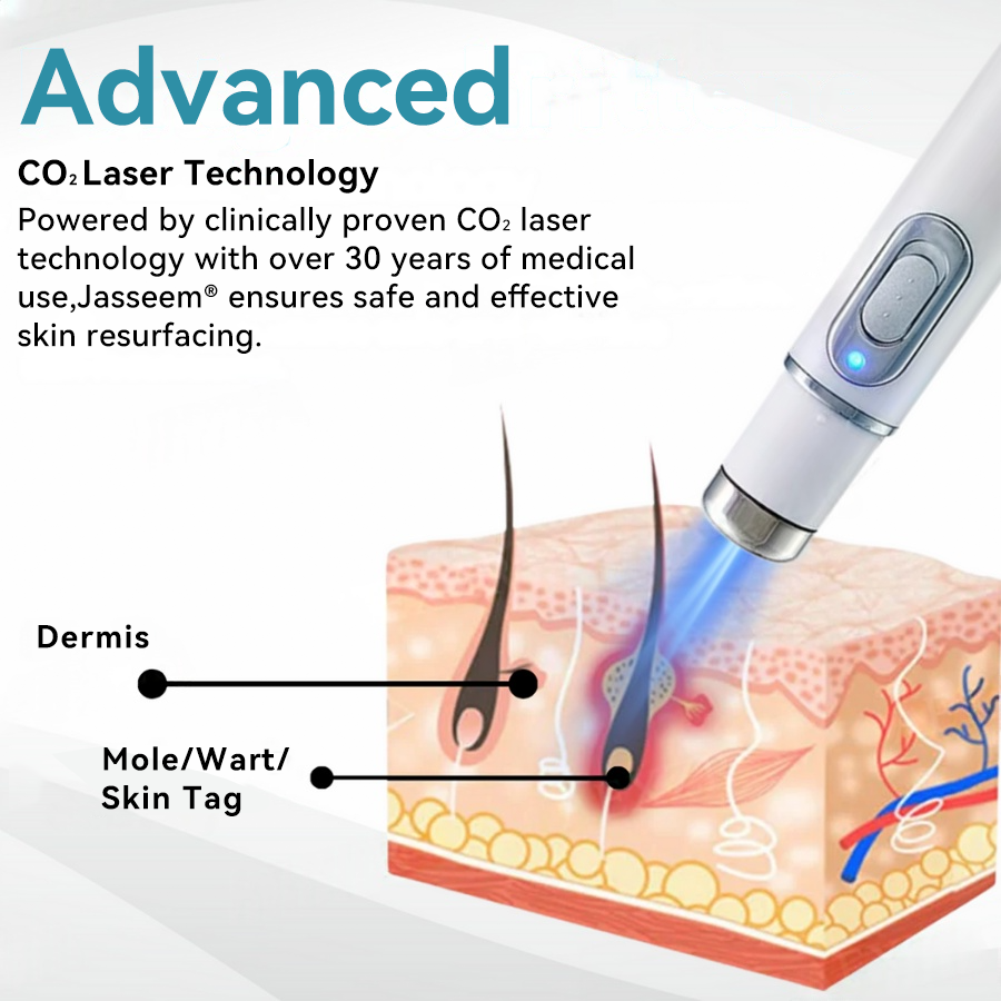 ๐๐๐ฌ๐ฌ๐๐๐ฆยฎ Medical-Grade Laser Pen ๐๐(Powered by COโ laser technology โ effectively removes moles, warts, skin tags, pigmentation marks, and other skin imperfections)