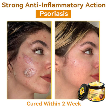 𝐃𝐨𝐫𝐦𝐨𝐫𝐧𝐚®💧Bee Venom Repair Cream (Anti-aging, deep hydration, skin repair, even skin tone, acne and dark spot treatment, removal of warts and moles, and psoriasis relief)