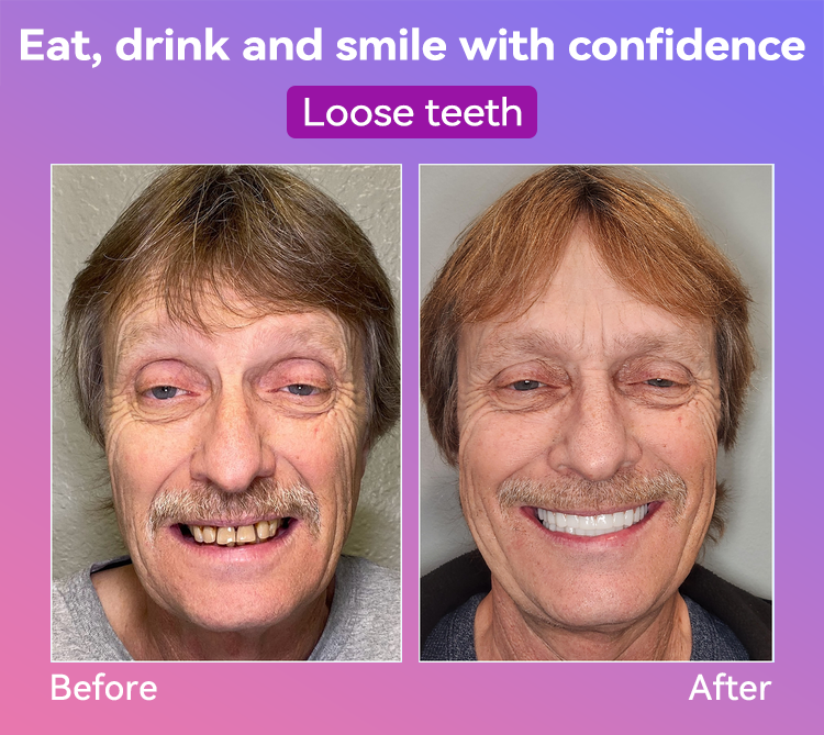 𝐉𝐚𝐬𝐬𝐞𝐞𝐦® Latest Premium Comfort Dentures🎁(High-End Dentures, Easy to Wear - Limited Time 70% Discount)
