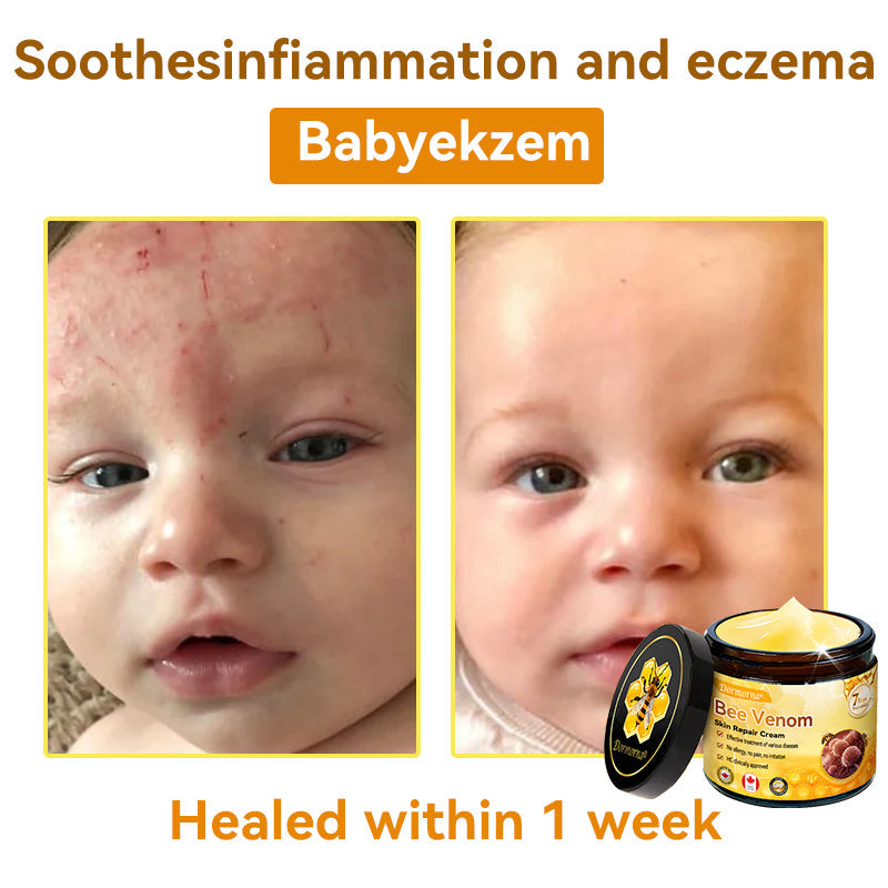 𝐃𝐨𝐫𝐦𝐨𝐫𝐧𝐚®💧Bee Venom Repair Cream (Anti-aging, deep hydration, skin repair, even skin tone, acne and dark spot treatment, removal of warts and moles, and psoriasis relief)