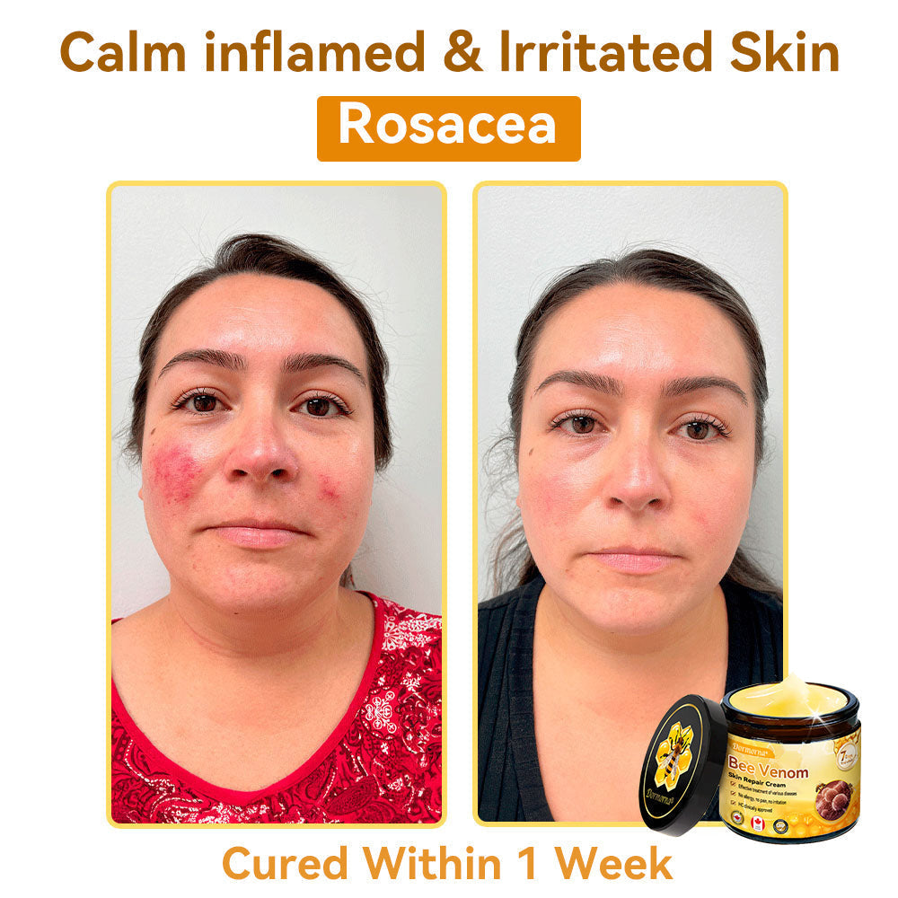 𝐃𝐨𝐫𝐦𝐨𝐫𝐧𝐚®💧Bee Venom Repair Cream (Anti-aging, deep hydration, skin repair, even skin tone, acne and dark spot treatment, removal of warts and moles, and psoriasis relief)