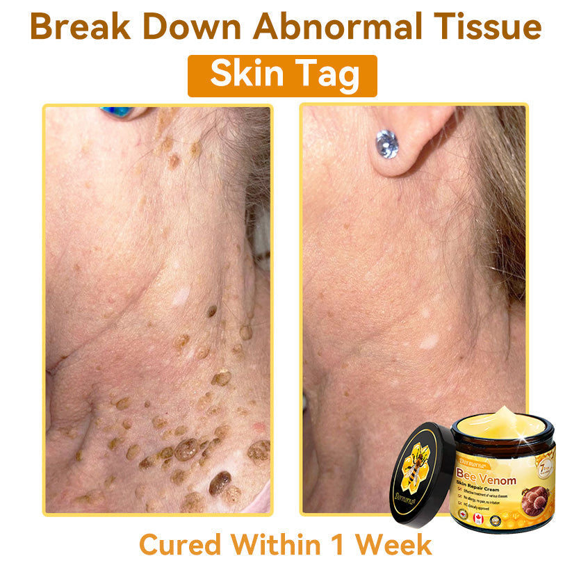 𝐃𝐨𝐫𝐦𝐨𝐫𝐧𝐚®💧Bee Venom Repair Cream (Anti-aging, deep hydration, skin repair, even skin tone, acne and dark spot treatment, removal of warts and moles, and psoriasis relief)