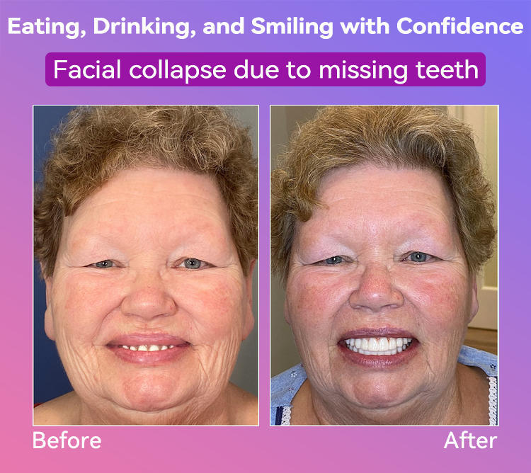 𝐉𝐚𝐬𝐬𝐞𝐞𝐦® Latest Premium Comfort Dentures🎁(High-End Dentures, Easy to Wear - Limited Time 70% Discount)