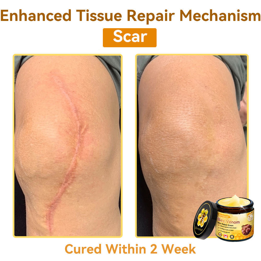 𝐃𝐨𝐫𝐦𝐨𝐫𝐧𝐚®💧Bee Venom Repair Cream (Anti-aging, deep hydration, skin repair, even skin tone, acne and dark spot treatment, removal of warts and moles, and psoriasis relief)