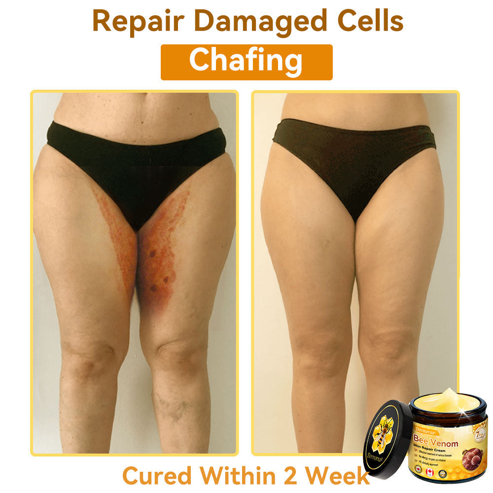 𝐃𝐨𝐫𝐦𝐨𝐫𝐧𝐚®💧Bee Venom Repair Cream (Anti-aging, deep hydration, skin repair, even skin tone, acne and dark spot treatment, removal of warts and moles, and psoriasis relief)