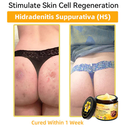 𝐃𝐨𝐫𝐦𝐨𝐫𝐧𝐚®💧Bee Venom Repair Cream (Anti-aging, deep hydration, skin repair, even skin tone, acne and dark spot treatment, removal of warts and moles, and psoriasis relief)