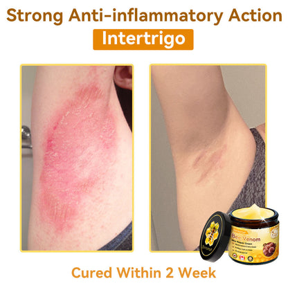 𝐃𝐨𝐫𝐦𝐨𝐫𝐧𝐚®💧Bee Venom Repair Cream (Anti-aging, deep hydration, skin repair, even skin tone, acne and dark spot treatment, removal of warts and moles, and psoriasis relief)