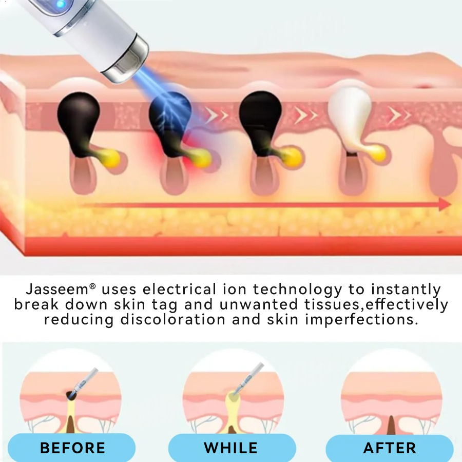 𝐉𝐚𝐬𝐬𝐞𝐞𝐦® Medical-Grade Laser Pen 🔥 (Powered by CO₂ laser technology – effectively removes moles, warts, skin tags, pigmentation marks, and other skin imperfections)🏆