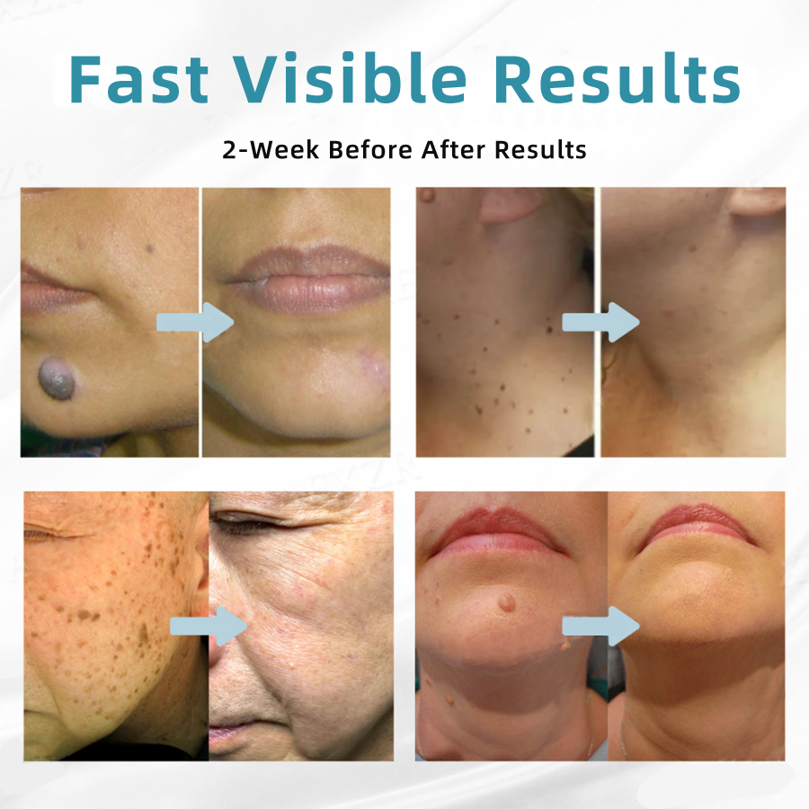 𝐉𝐚𝐬𝐬𝐞𝐞𝐦® Medical-Grade Laser Pen 🚚🎁(Powered by CO₂ laser technology – effectively removes moles, warts, skin tags, pigmentation marks, and other skin imperfections)