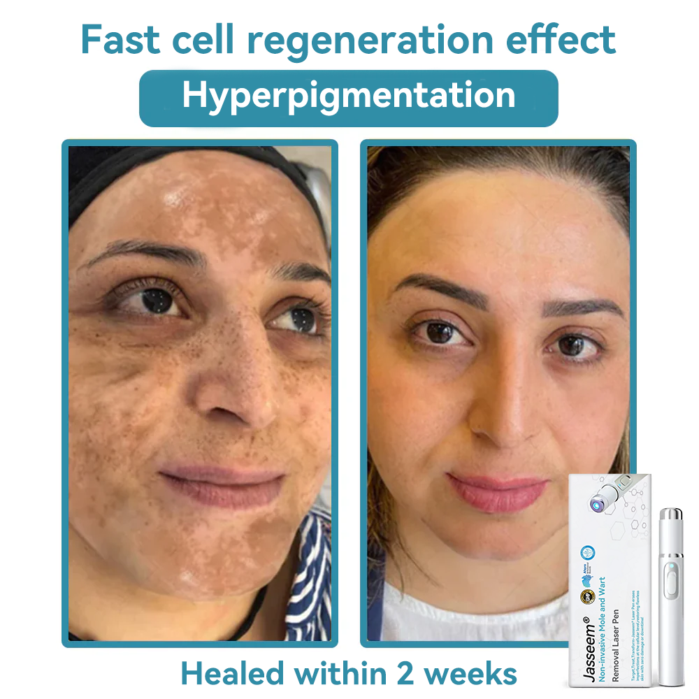 𝐉𝐚𝐬𝐬𝐞𝐞𝐦® Medical-Grade Laser Pen 🔥 (Powered by CO₂ laser technology – effectively removes moles, warts, skin tags, pigmentation marks, and other skin imperfections)🏆