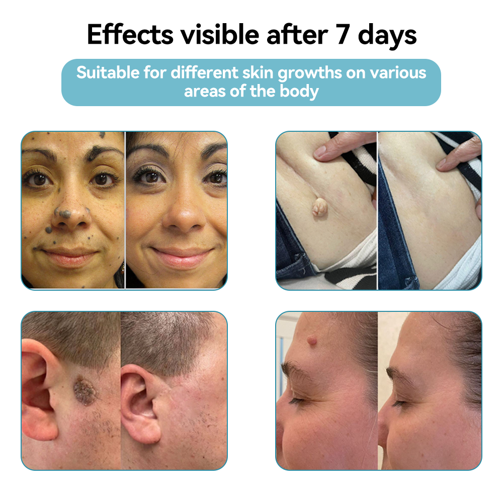 𝐉𝐚𝐬𝐬𝐞𝐞𝐦® Medical-Grade Laser Pen 🔥 (Powered by CO₂ laser technology – effectively removes moles, warts, skin tags, pigmentation marks, and other skin imperfections)🏆