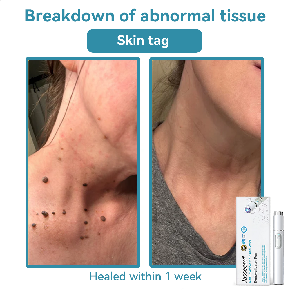 𝐉𝐚𝐬𝐬𝐞𝐞𝐦® Medical-Grade Laser Pen 🔥 (Powered by CO₂ laser technology – effectively removes moles, warts, skin tags, pigmentation marks, and other skin imperfections)🏆