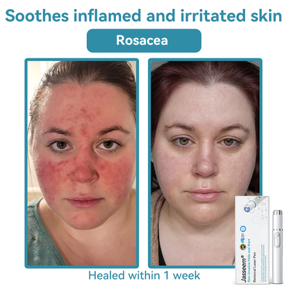 𝐉𝐚𝐬𝐬𝐞𝐞𝐦® Medical-Grade Laser Pen 🚚🎁(Powered by CO₂ laser technology – effectively removes moles, warts, skin tags, pigmentation marks, and other skin imperfections)