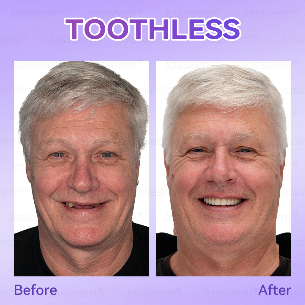 𝐉𝐚𝐬𝐬𝐞𝐞𝐦® Latest Premium Comfort Dentures💧 (High-End Dentures, Easy to Wear - Limited Time 70% Off)🔥